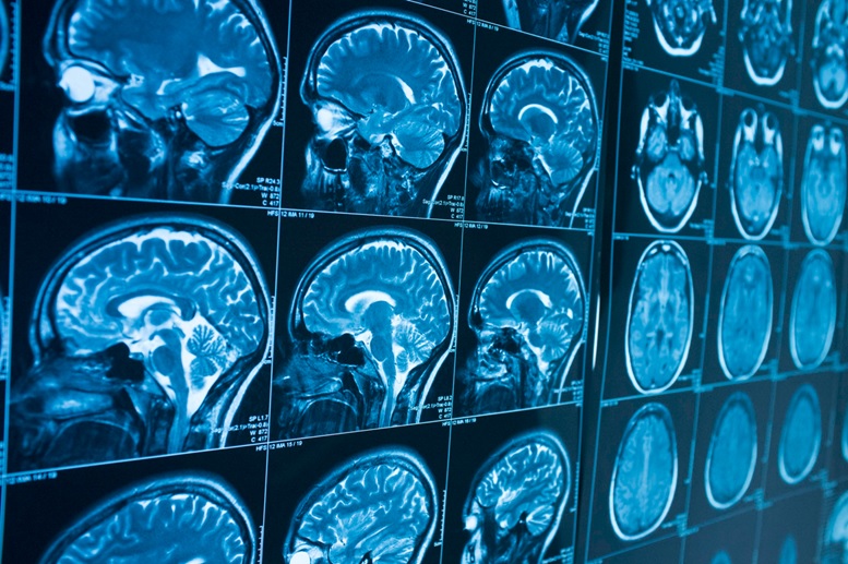هوش مصنوعی ده سال زودتر از بروز نشانه‌ها، آلزایمر را تشخیص می‌دهد
