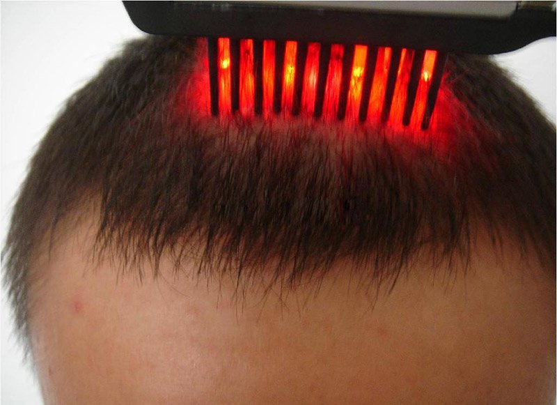 فناوری‌های عجیب زیبایی: لیزرهای تقویت مو