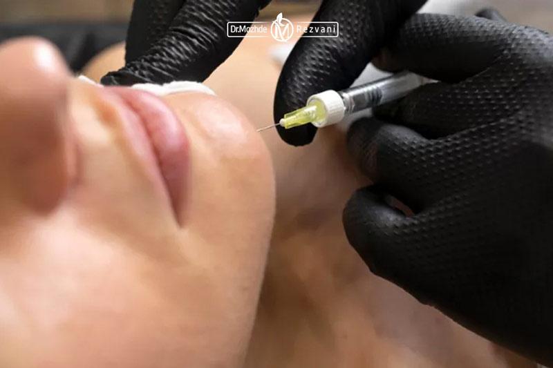 تزریق فیلر چانه بهترین راه برای قرینه سازی صورت
