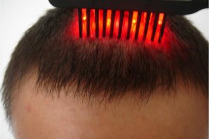 فناوری‌های عجیب زیبایی: لیزرهای تقویت مو