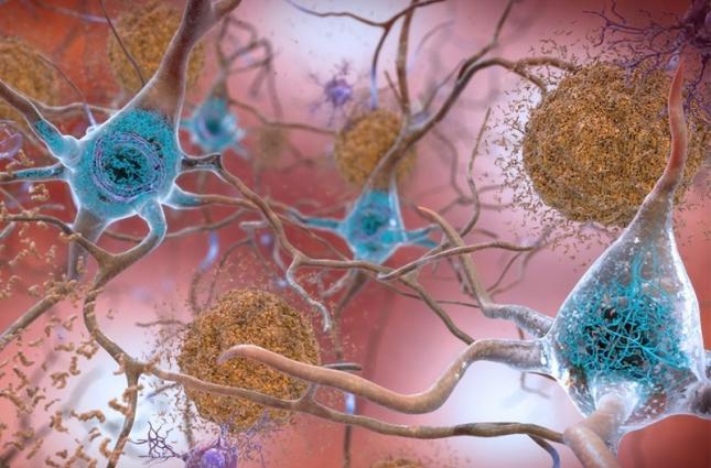 تاثیر لکه‌های پروتئینی مرتبط با آلزایمر بر پیری تمام سلول‌ها